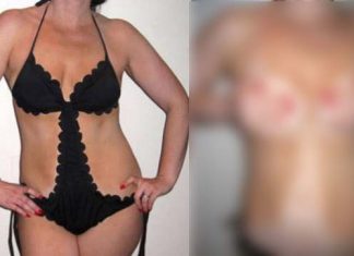 Biquínis ‘diferentões’ estão deixando marcas esquisitas nas mulheres