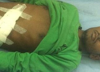 Rapaz de 18 anos sente dores no abdômen, vai ao médico, faz cesária e retira feto-gêmeo