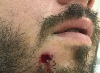 Turista foi baleado no rosto durante roubo no Guarujá e tira projétil da boca com a mão; ‘Milagre’