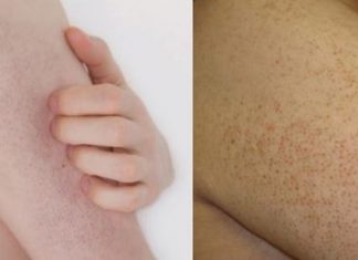 Já notou essas manchas vermelhas na sua pele? Saiba porque elas existem.