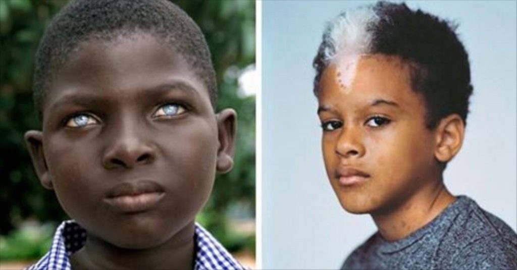 11 anomalias genéticas que tornam os humanos unicamente bonitos ...